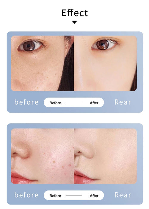 Laser pen with adjustable intensity and frequency for various skin concerns