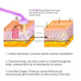 Neon and argon wands offer versatile skin therapy benefits