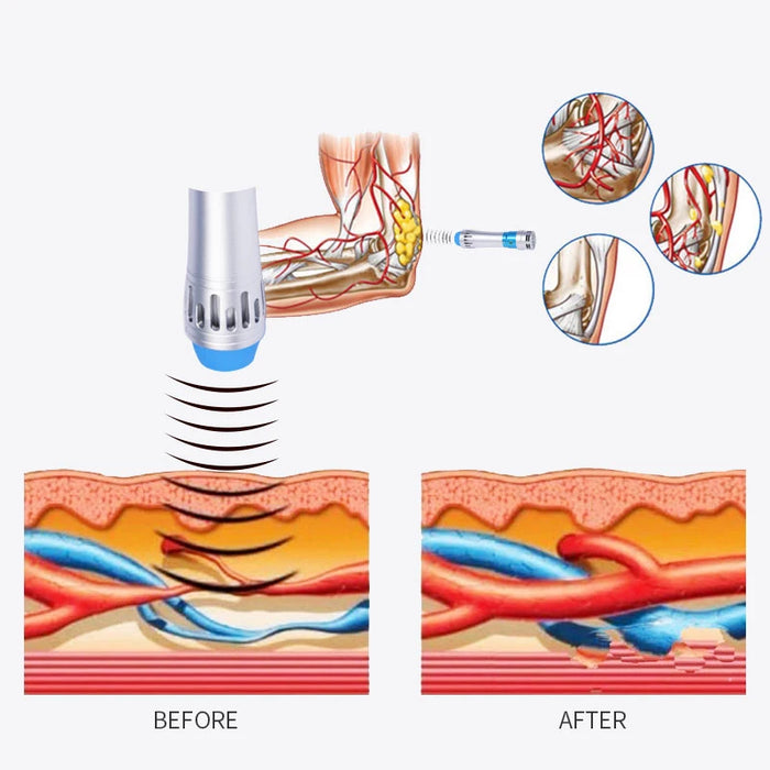 AU plug type for physiotherapy, muscle pain relief, and sports recovery